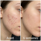 Kinetica Clarté — Soin Anti-Cicatrices & Marques d'Acné | Silicone Médical