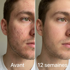 Kinetica Clarté — Soin Anti-Cicatrices & Marques d'Acné | Silicone Médical